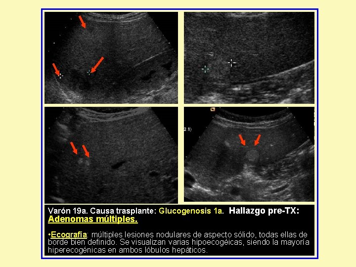 Varón 19 a. Causa trasplante: Glucogenosis 1 a. Hallazgo pre-TX: Adenomas múltiples. • Ecografía: Varón 19 a. Causa trasplante: Glucogenosis 1 a. Hallazgo pre-TX: Adenomas múltiples. • Ecografía: