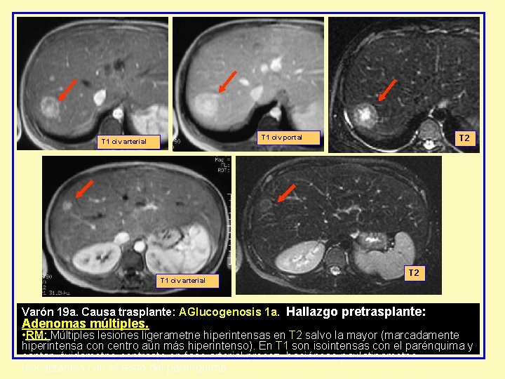 T 1 civ portal T 1 civ arterial T 2 Varón 19 a. Causa T 1 civ portal T 1 civ arterial T 2 Varón 19 a. Causa