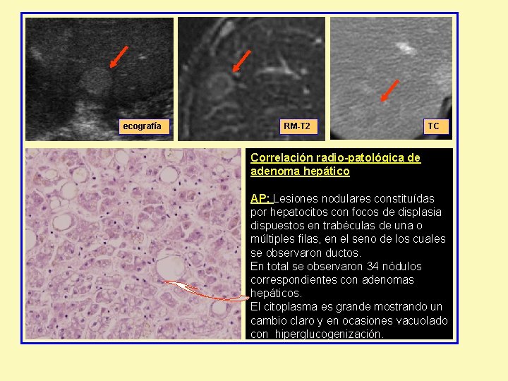 ecografía RM-T 2 TC Correlación radio-patológica de adenoma hepático AP: Lesiones nodulares constituídas por ecografía RM-T 2 TC Correlación radio-patológica de adenoma hepático AP: Lesiones nodulares constituídas por