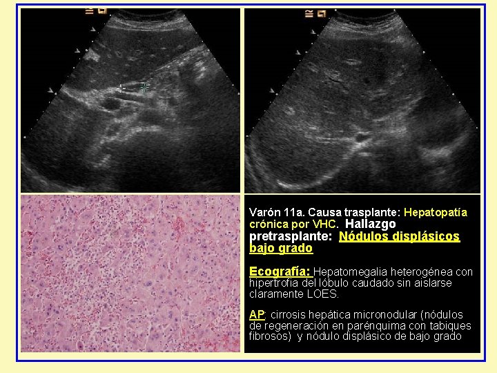 Varón 11 a. Causa trasplante: Hepatopatía crónica por VHC. Hallazgo pretrasplante: Nódulos displásicos bajo Varón 11 a. Causa trasplante: Hepatopatía crónica por VHC. Hallazgo pretrasplante: Nódulos displásicos bajo