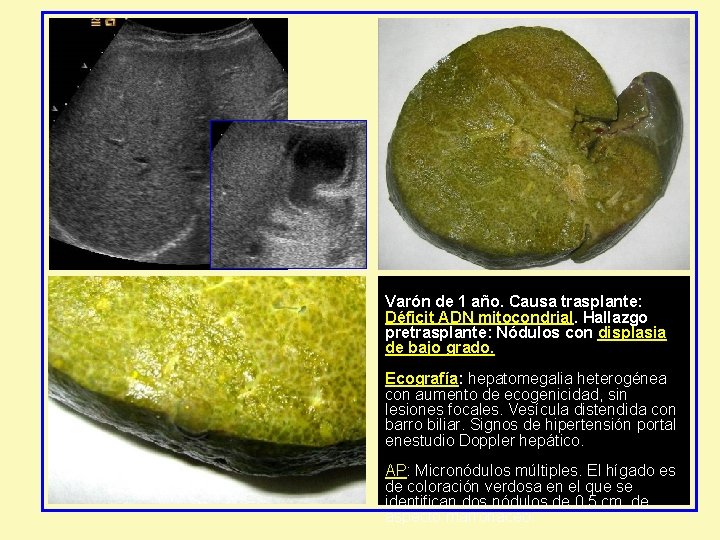 Varón de 1 año. Causa trasplante: Déficit ADN mitocondrial. Hallazgo pretrasplante: Nódulos con displasia Varón de 1 año. Causa trasplante: Déficit ADN mitocondrial. Hallazgo pretrasplante: Nódulos con displasia