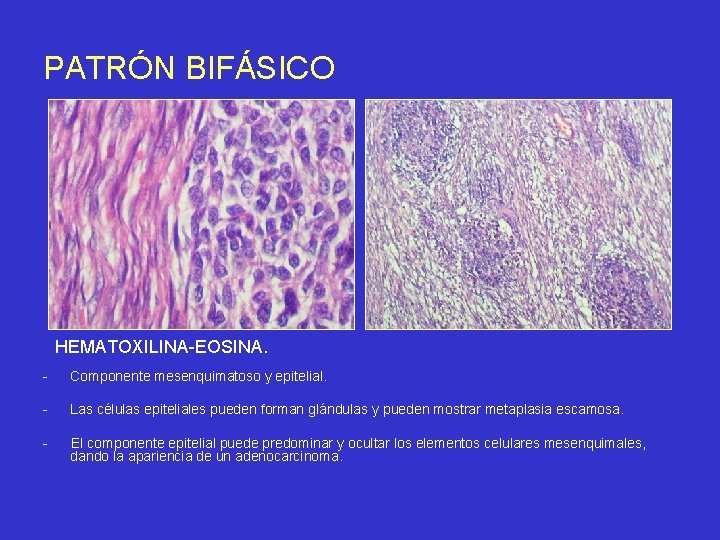 PATRÓN BIFÁSICO HEMATOXILINA-EOSINA. - Componente mesenquimatoso y epitelial. - Las células epiteliales pueden forman