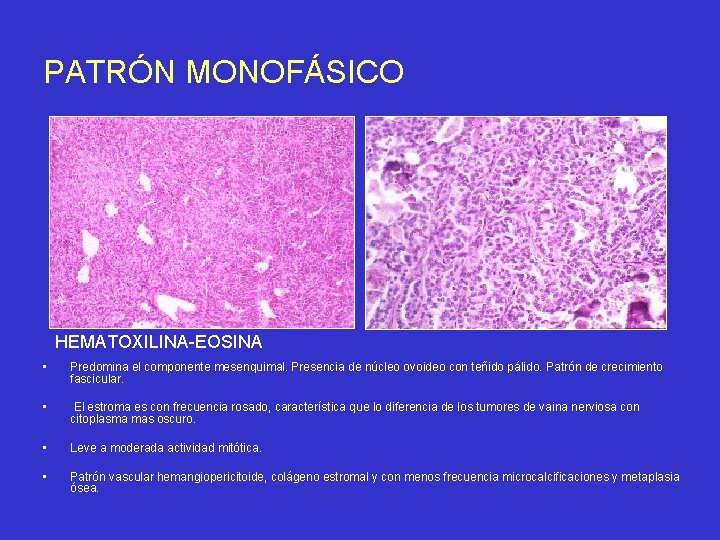 PATRÓN MONOFÁSICO HEMATOXILINA-EOSINA • Predomina el componente mesenquimal. Presencia de núcleo ovoideo con teñido