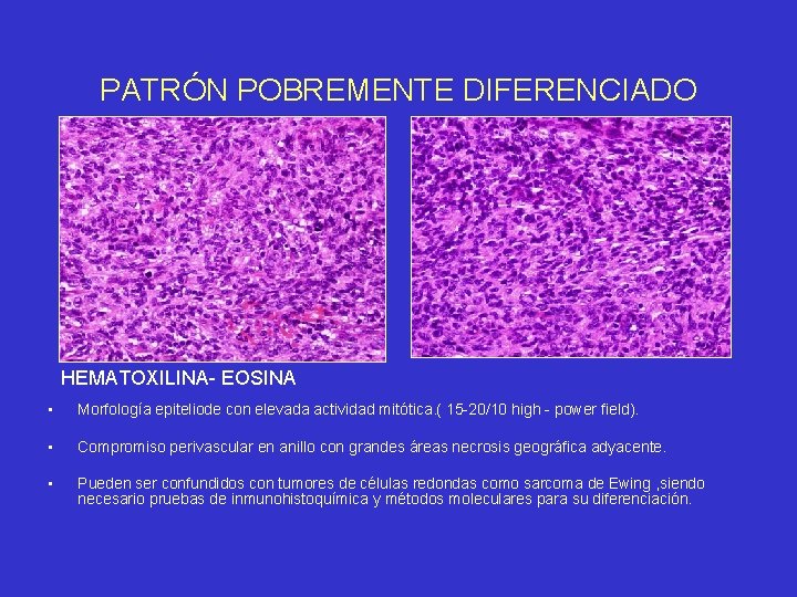 PATRÓN POBREMENTE DIFERENCIADO HEMATOXILINA- EOSINA • Morfología epiteliode con elevada actividad mitótica. ( 15