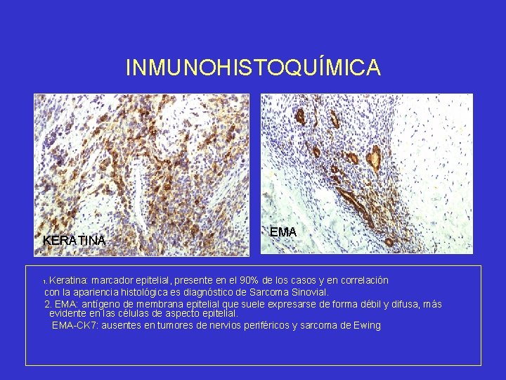 INMUNOHISTOQUÍMICA KERATINA EMA Keratina: marcador epitelial, presente en el 90% de los casos y