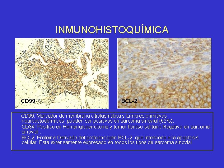 INMUNOHISTOQUÍMICA CD 99 BCL-2 CD 99: Marcador de membrana citiplasmática y tumores primitivos neuroectodérmicos,