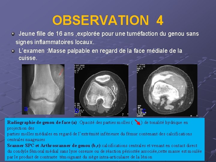 OBSERVATION 4 Jeune fille de 16 ans , explorée pour une tuméfaction du genou