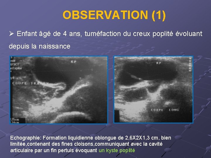 OBSERVATION (1) Ø Enfant âgé de 4 ans, tuméfaction du creux poplité évoluant depuis