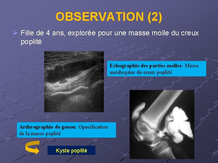 OBSERVATION (2) Ø Fille de 4 ans, explorée pour une masse molle du creux