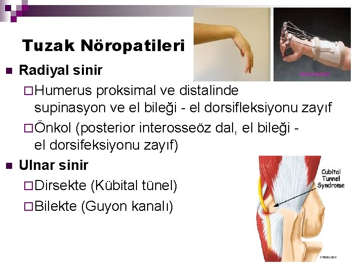 Tuzak Nöropatileri n n Radiyal sinir ¨ Humerus proksimal ve distalinde supinasyon ve el