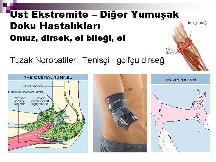 Üst Ekstremite – Diğer Yumuşak Doku Hastalıkları Omuz, dirsek, el bileği, el Tuzak Nöropatileri,