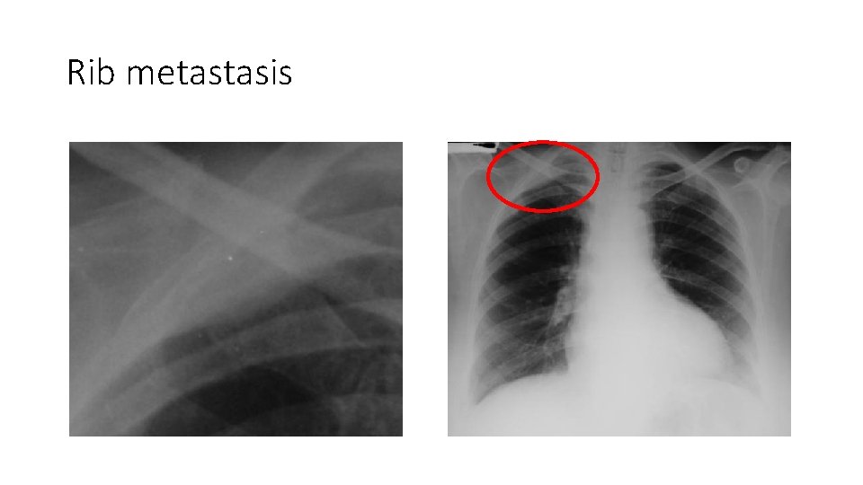 Rib metastasis 