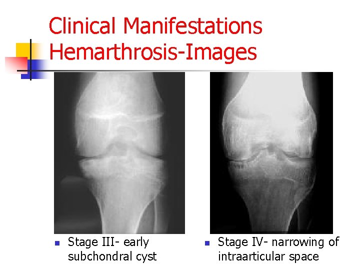 Clinical Manifestations Hemarthrosis-Images n Stage III- early subchondral cyst n Stage IV- narrowing of