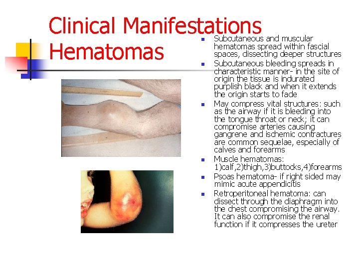 Clinical Manifestations Hematomas n n n Subcutaneous and muscular hematomas spread within fascial spaces,