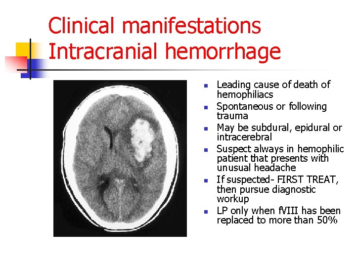 Clinical manifestations Intracranial hemorrhage n n n Leading cause of death of hemophiliacs Spontaneous