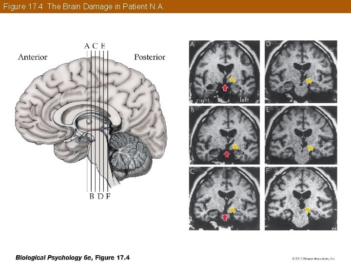 Figure 17. 4 The Brain Damage in Patient N. A. 