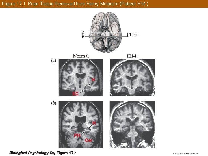 Figure 17. 1 Brain Tissue Removed from Henry Molaison (Patient H. M. ) 