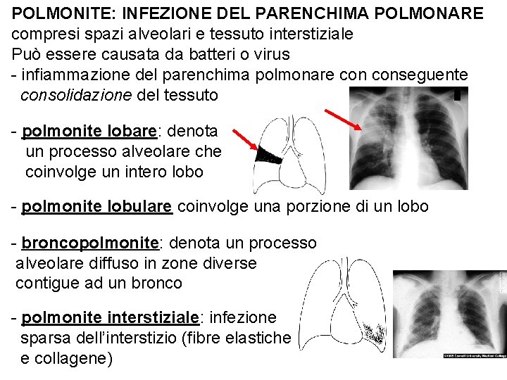 POLMONITE: INFEZIONE DEL PARENCHIMA POLMONARE compresi spazi alveolari e tessuto interstiziale Può essere causata