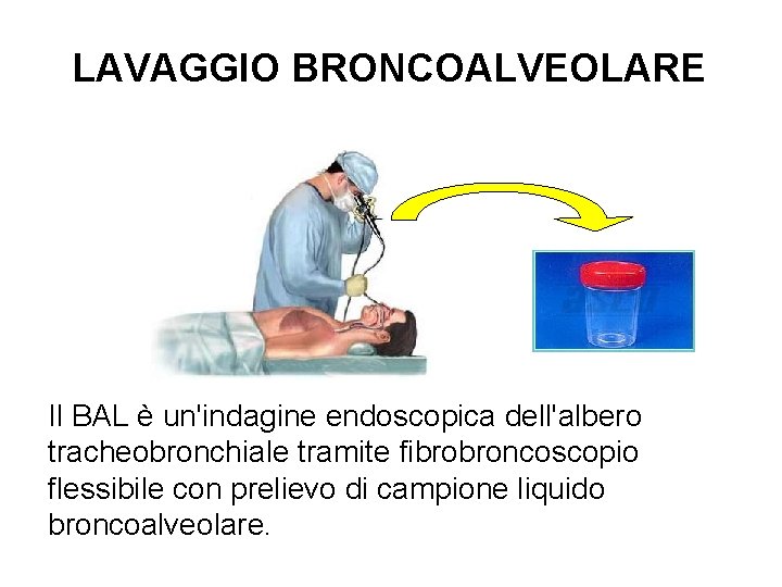 LAVAGGIO BRONCOALVEOLARE Il BAL è un'indagine endoscopica dell'albero tracheobronchiale tramite fibrobroncoscopio flessibile con prelievo