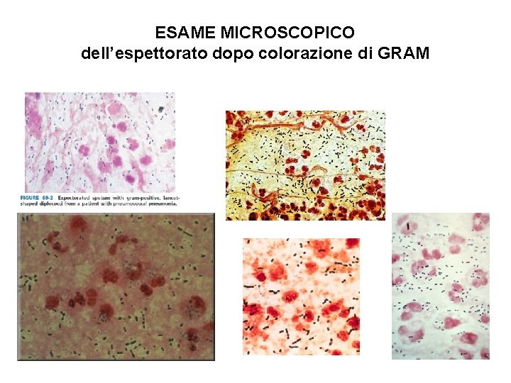  ESAME MICROSCOPICO dell’espettorato dopo colorazione di GRAM 