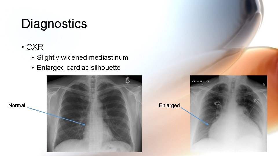 Diagnostics • CXR • Slightly widened mediastinum • Enlarged cardiac silhouette Normal Enlarged Diagnostics • CXR • Slightly widened mediastinum • Enlarged cardiac silhouette Normal Enlarged