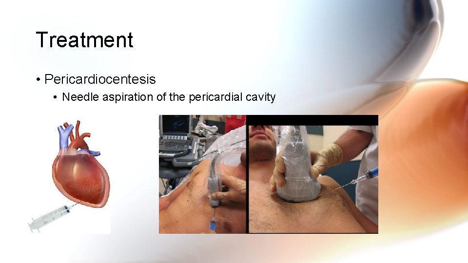 Treatment • Pericardiocentesis • Needle aspiration of the pericardial cavity Treatment • Pericardiocentesis • Needle aspiration of the pericardial cavity