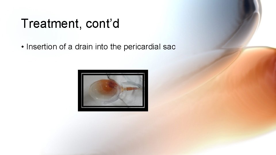 Treatment, cont’d • Insertion of a drain into the pericardial sac Treatment, cont’d • Insertion of a drain into the pericardial sac