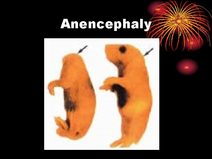 Anencephaly 