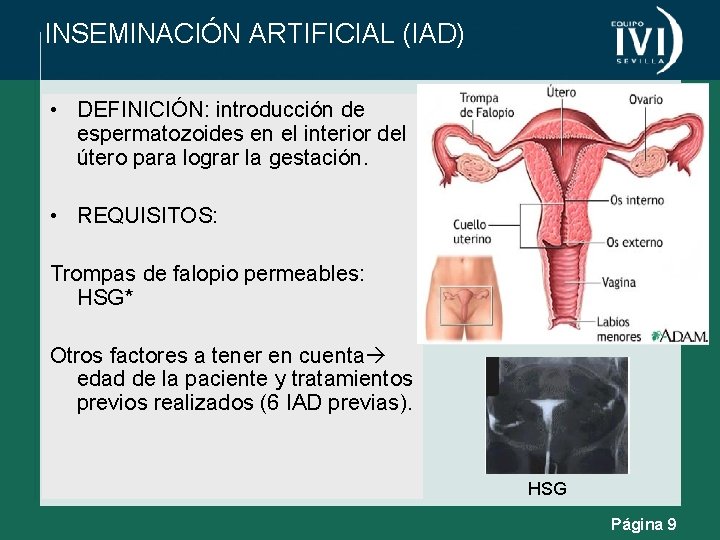 INSEMINACIÓN ARTIFICIAL (IAD) • DEFINICIÓN: introducción de espermatozoides en el interior del útero para