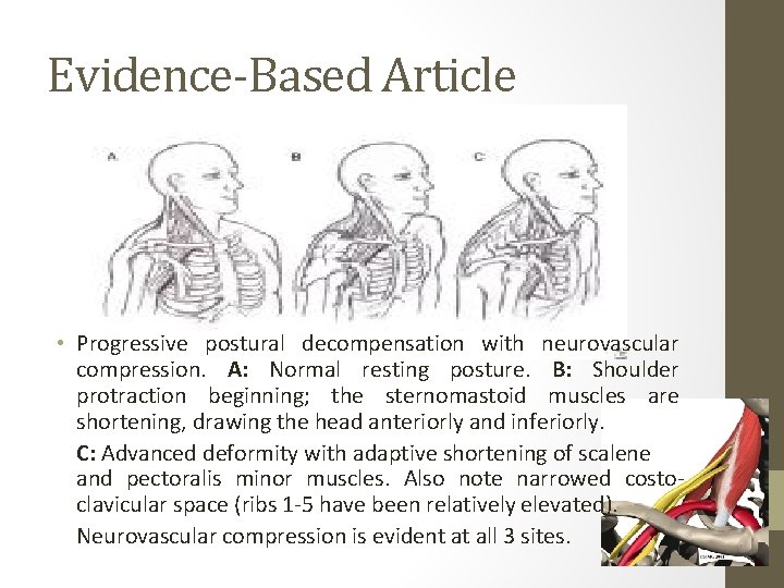 Evidence-Based Article • Progressive postural decompensation with neurovascular compression. A: Normal resting posture. B:
