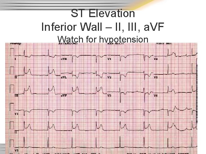 ST Elevation Inferior Wall – II, III, a. VF Watch for hypotension 