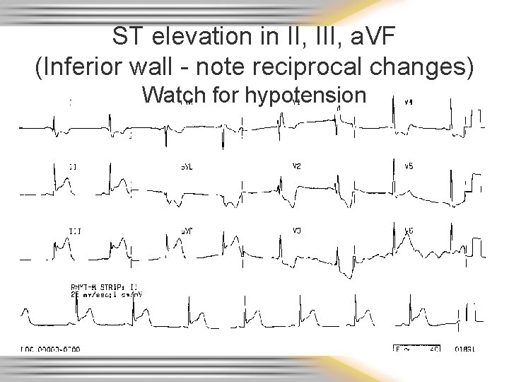 ST elevation in II, III, a. VF (Inferior wall - note reciprocal changes) Watch