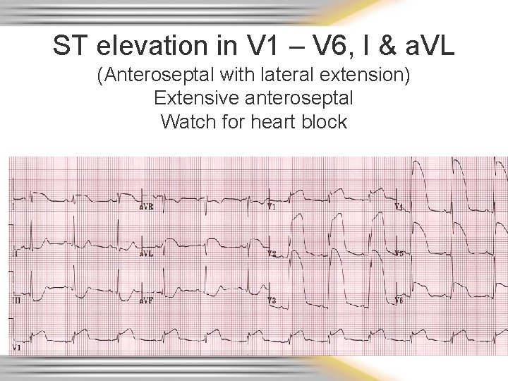 ST elevation in V 1 – V 6, I & a. VL (Anteroseptal with