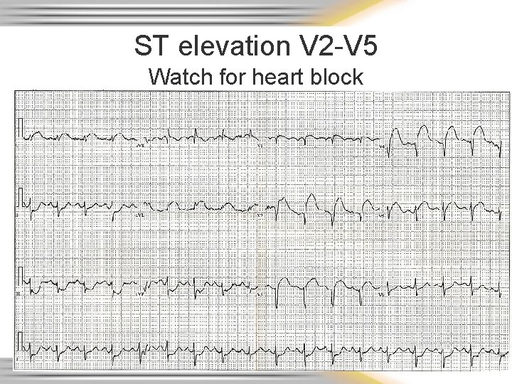 ST elevation V 2 -V 5 Watch for heart block 