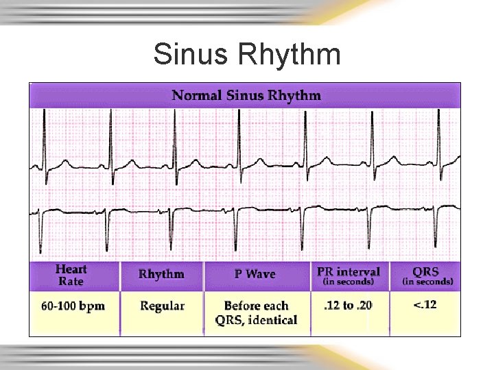 Sinus Rhythm 