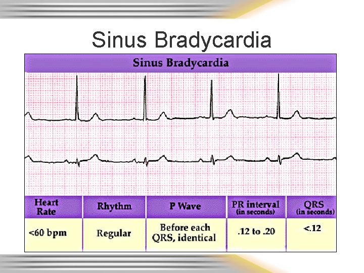 Sinus Bradycardia 