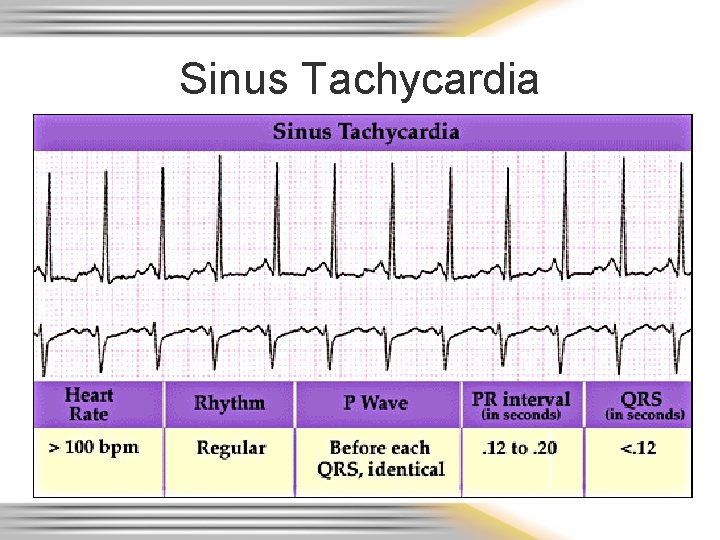 Sinus Tachycardia 