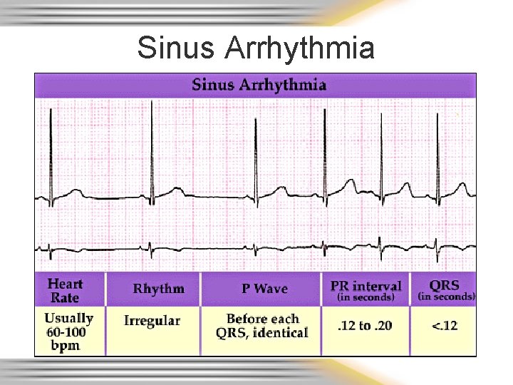 Sinus Arrhythmia 