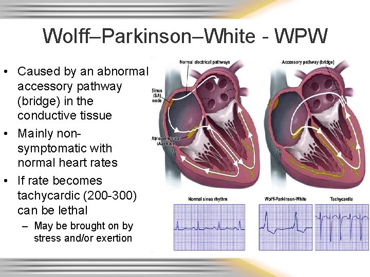 Wolff–Parkinson–White - WPW • Caused by an abnormal accessory pathway (bridge) in the conductive