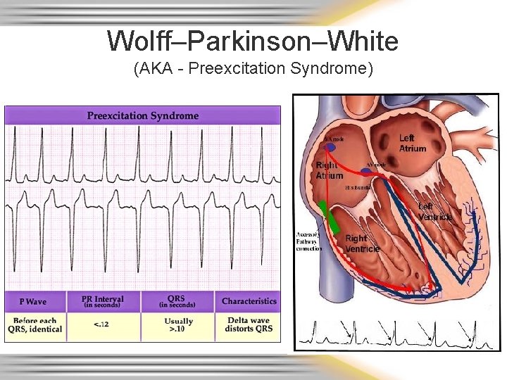 Wolff–Parkinson–White (AKA - Preexcitation Syndrome) 