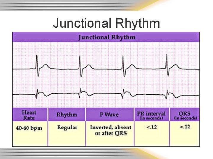 Junctional Rhythm 