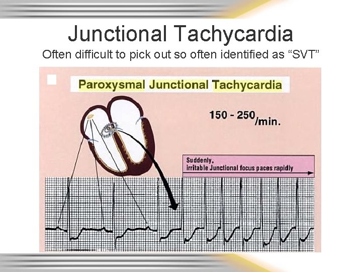 Junctional Tachycardia Often difficult to pick out so often identified as “SVT” 