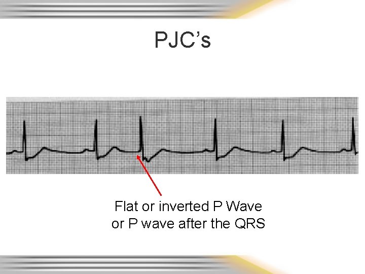 PJC’s Flat or inverted P Wave or P wave after the QRS 