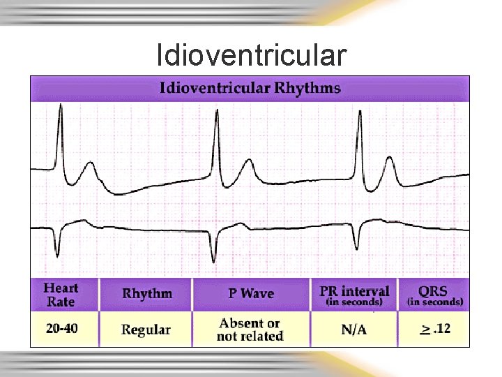 Idioventricular 