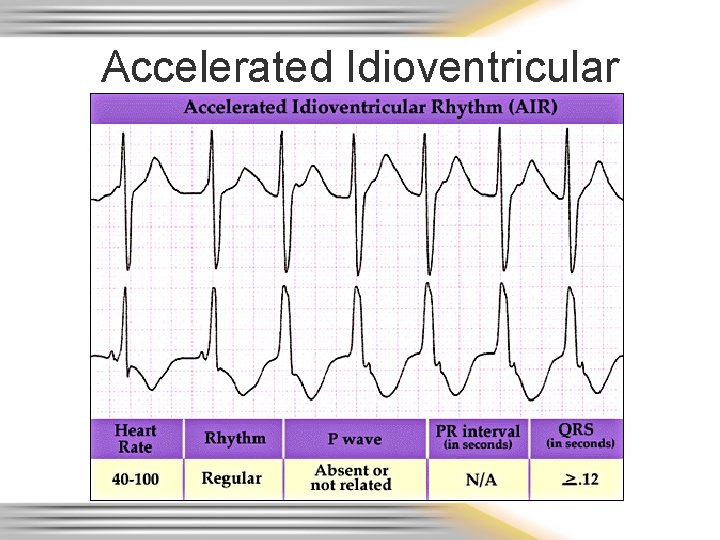 Accelerated Idioventricular 