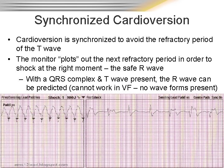 Synchronized Cardioversion • Cardioversion is synchronized to avoid the refractory period of the T