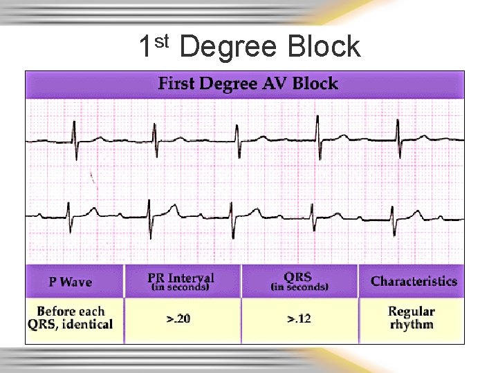 1 st Degree Block 