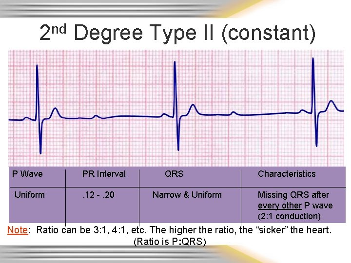 2 nd Degree Type II (constant) P Wave PR Interval Uniform . 12 -.