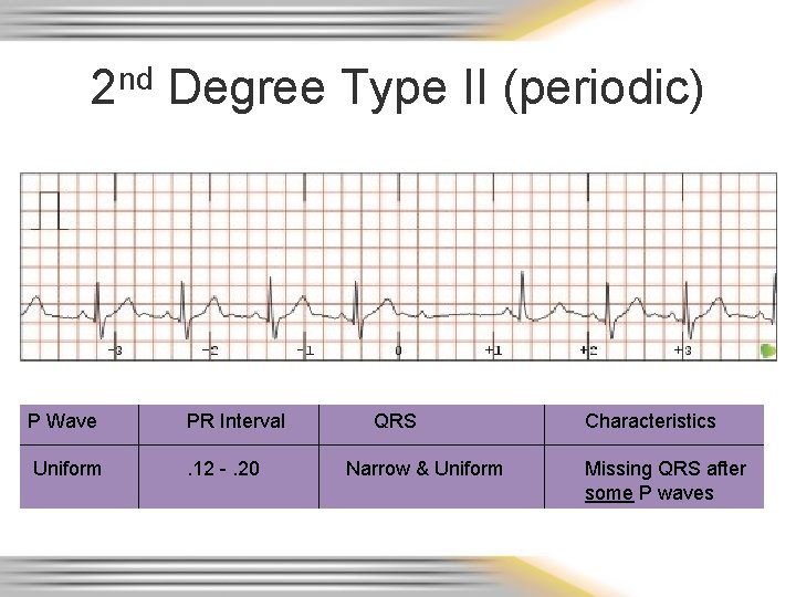 2 nd Degree Type II (periodic) P Wave PR Interval Uniform . 12 -.