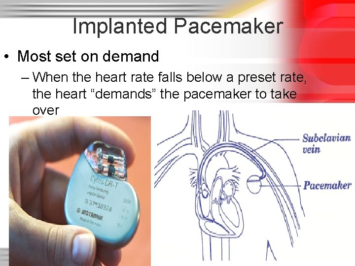 Implanted Pacemaker • Most set on demand – When the heart rate falls below